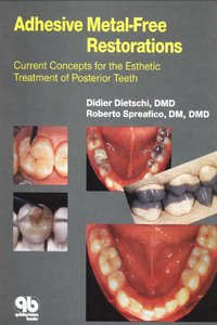 Adhesive Metal-Free Restorations: Current Concepts for the Esthetic Treatment of Posterior Teeth