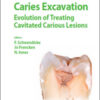 Caries Excavation: Evolution of Treating Cavitated Carious Lesions Caries Excavation: Evolution of Treating Cavitated Carious Lesions