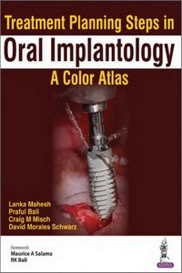 Treatment Planning Steps in Oral Implantology: A Color Atlas