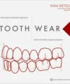 Tooth Wear: Interceptive Treatment Approach with Minimally Invasive Protocols