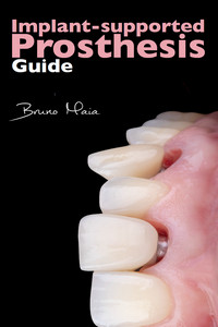 Implant-Supported Prosthesis Guide