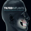 Tilted Implants: Implant-Prosthetic Rehabilitation of the Atrophic Patient Tilted Implants: Implant-Prosthetic Rehabilitation of the Atrophic Patient